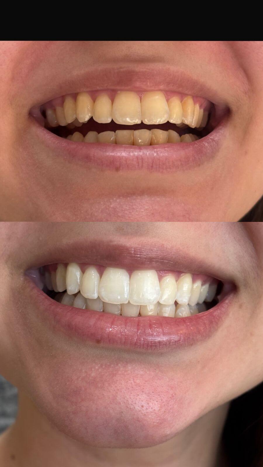 Antes e depois de clareamento dental